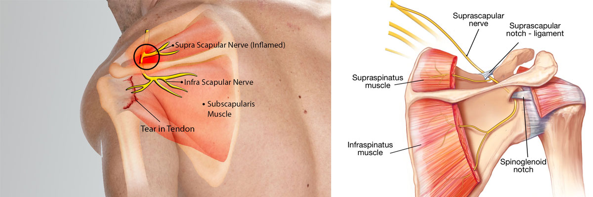 spinoglenoid notch